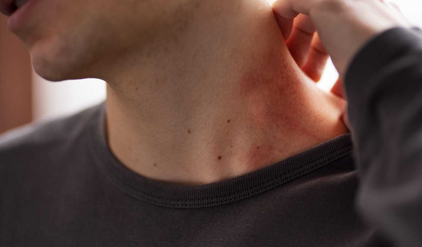 Seborrheic dermatitis - treatment Warsaw