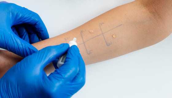 Czym jest alergia i jak powstaje? Jakie wybrać testy alergologiczne?