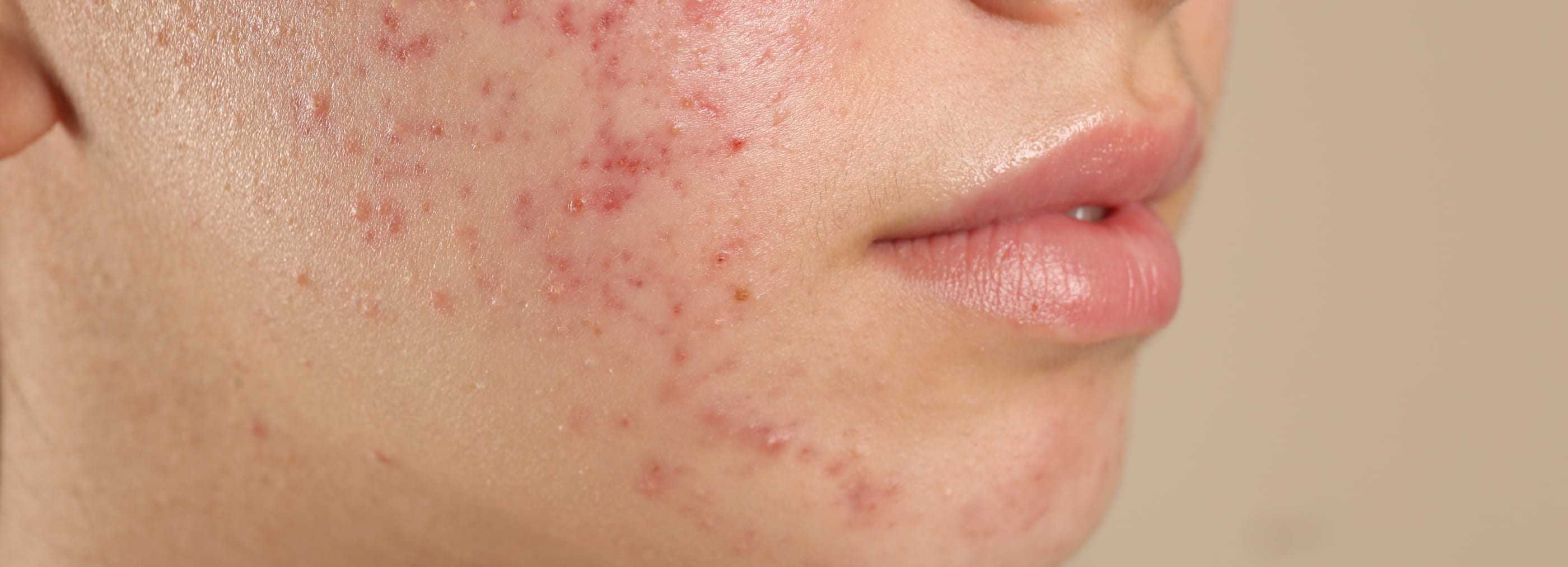 Rosacea Treatment Warsaw and Płock | OpenMed Medical Centre
