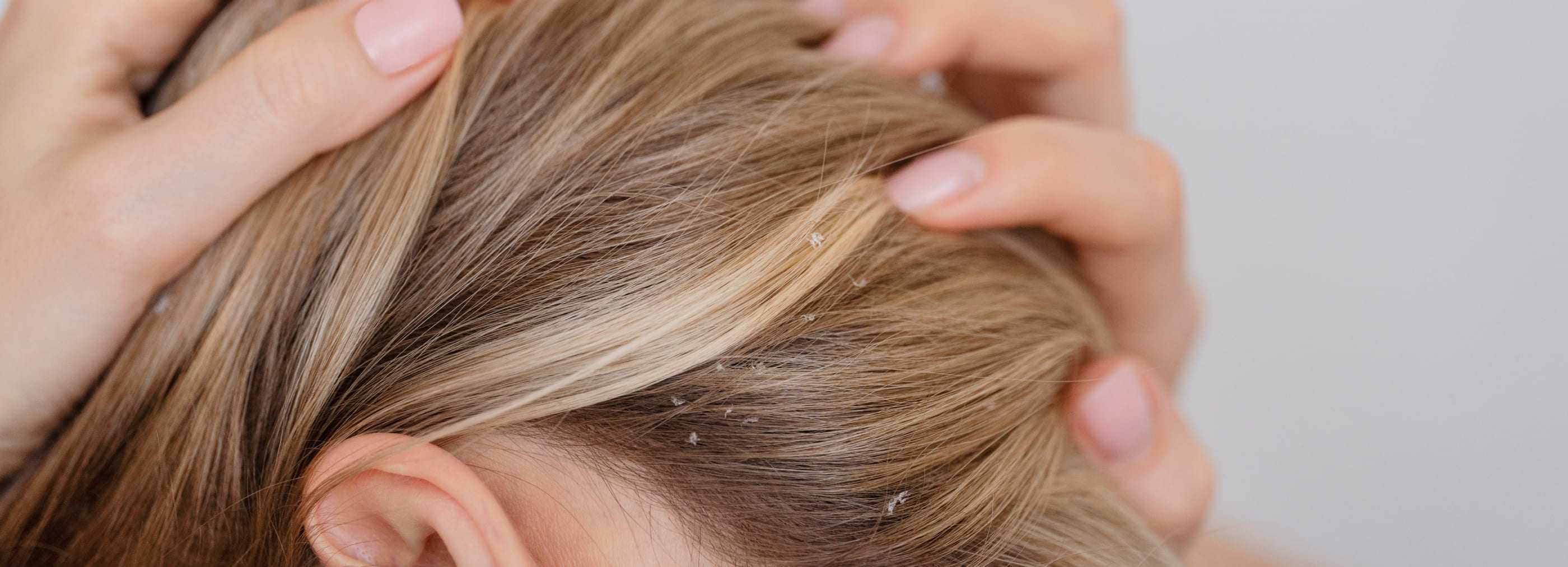 Łupież - leczenie dermatologiczne i konsultacje - Warszawa | OpenMed