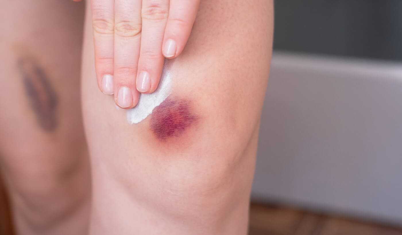 Bruising and easy haematoma diagnosis Warsaw Wola and Płock | OpenMed