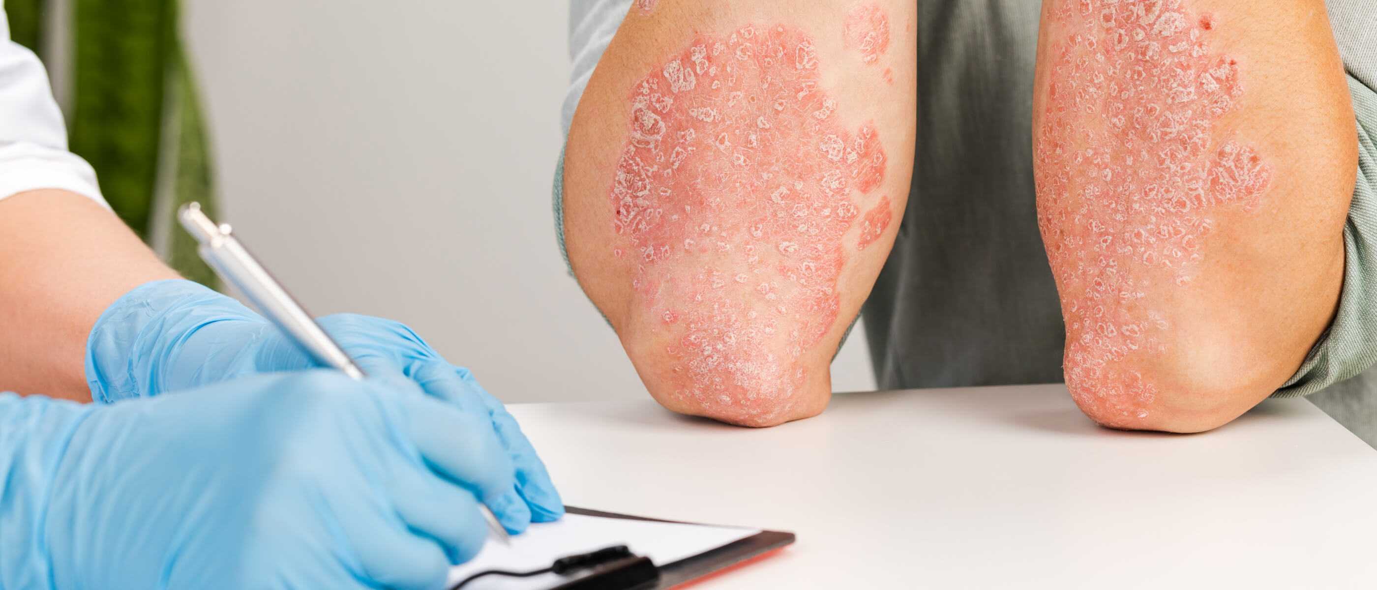 Psoriasis diagnosis and treatment in Warsaw | OpenMed Medical Centre