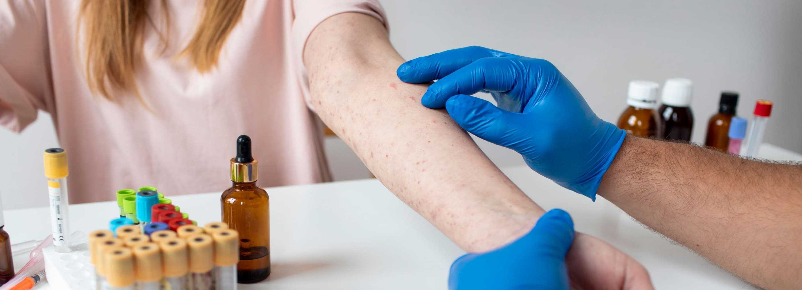 Testy alergologiczne Warszawa i Płock | OpenMed Centrum Medyczne