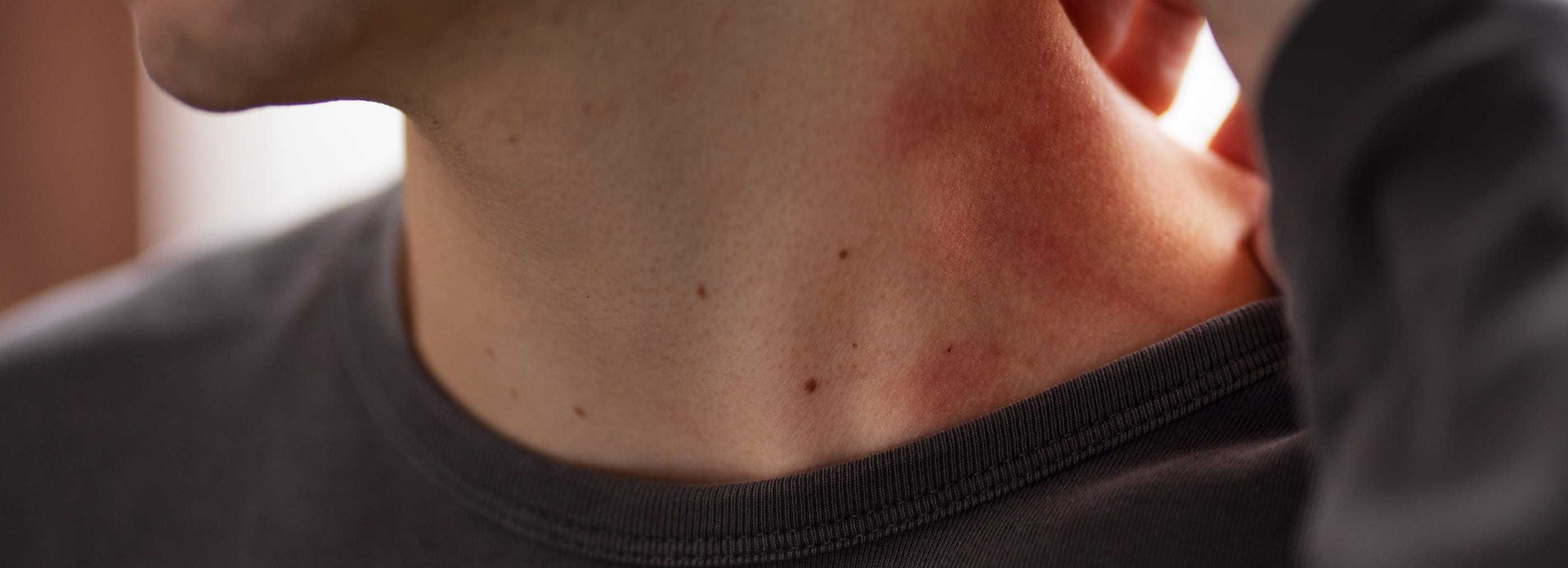 Seborrheic dermatitis - treatment Warsaw