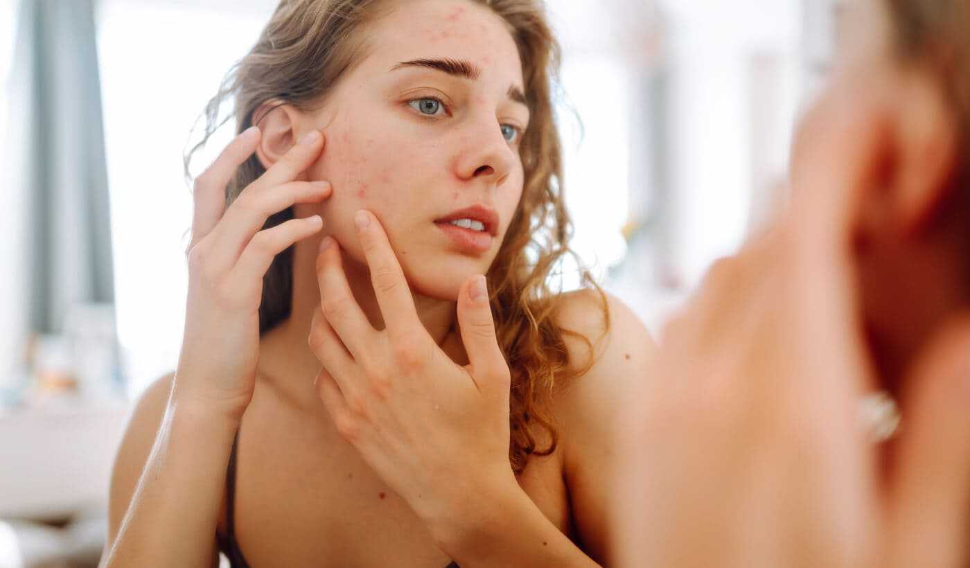 Platelet-rich plasma (PRP) for acne scars Warsaw Wola and Płock | OpenMed