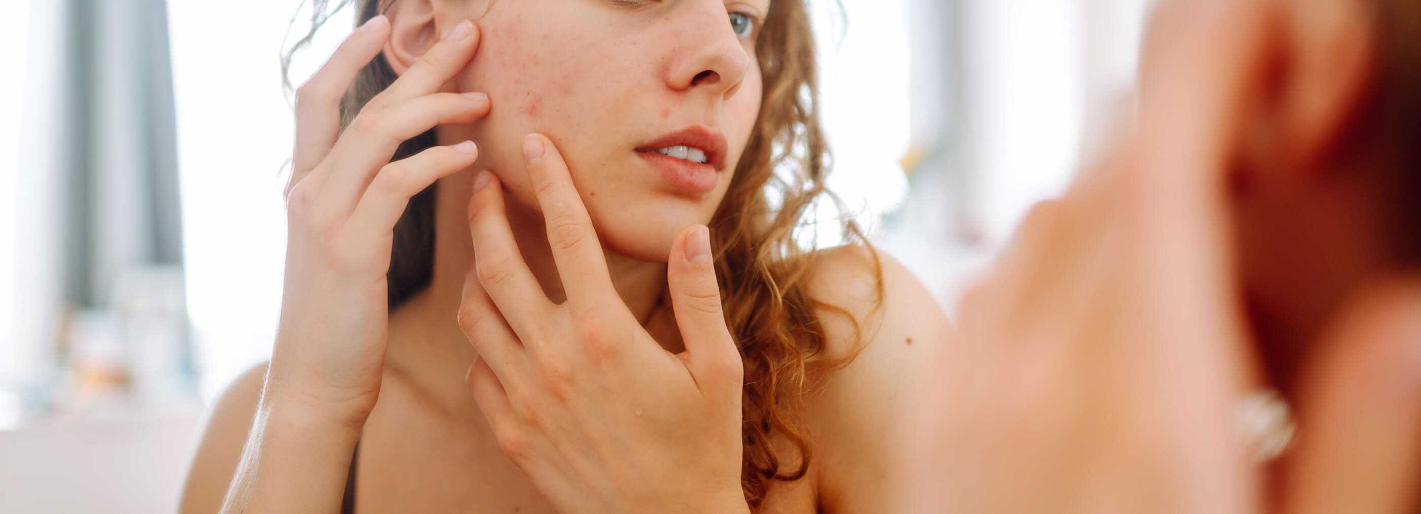 Platelet-rich plasma (PRP) for acne scars Warsaw Wola and Płock | OpenMed