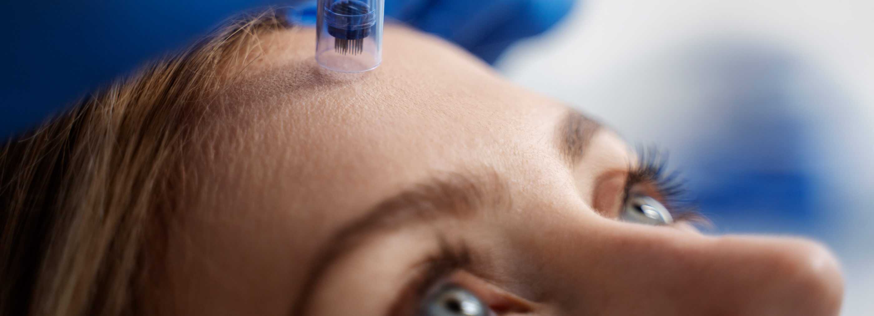 Usuwanie zmian skórnych (PLASMA IQ, łyżeczkowanie, wymrażanie) Warszawa | OpenMed