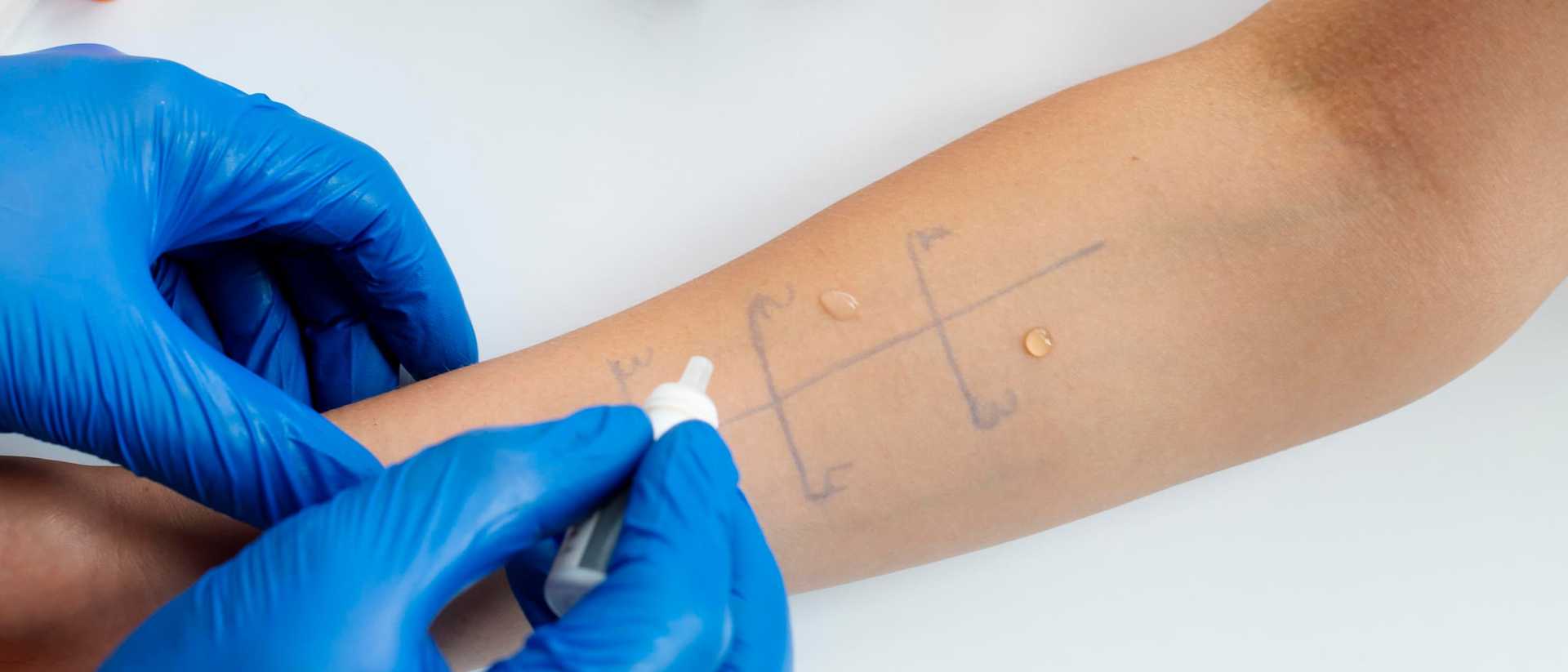 Czym jest alergia i jak powstaje? Jakie wybrać testy alergologiczne?