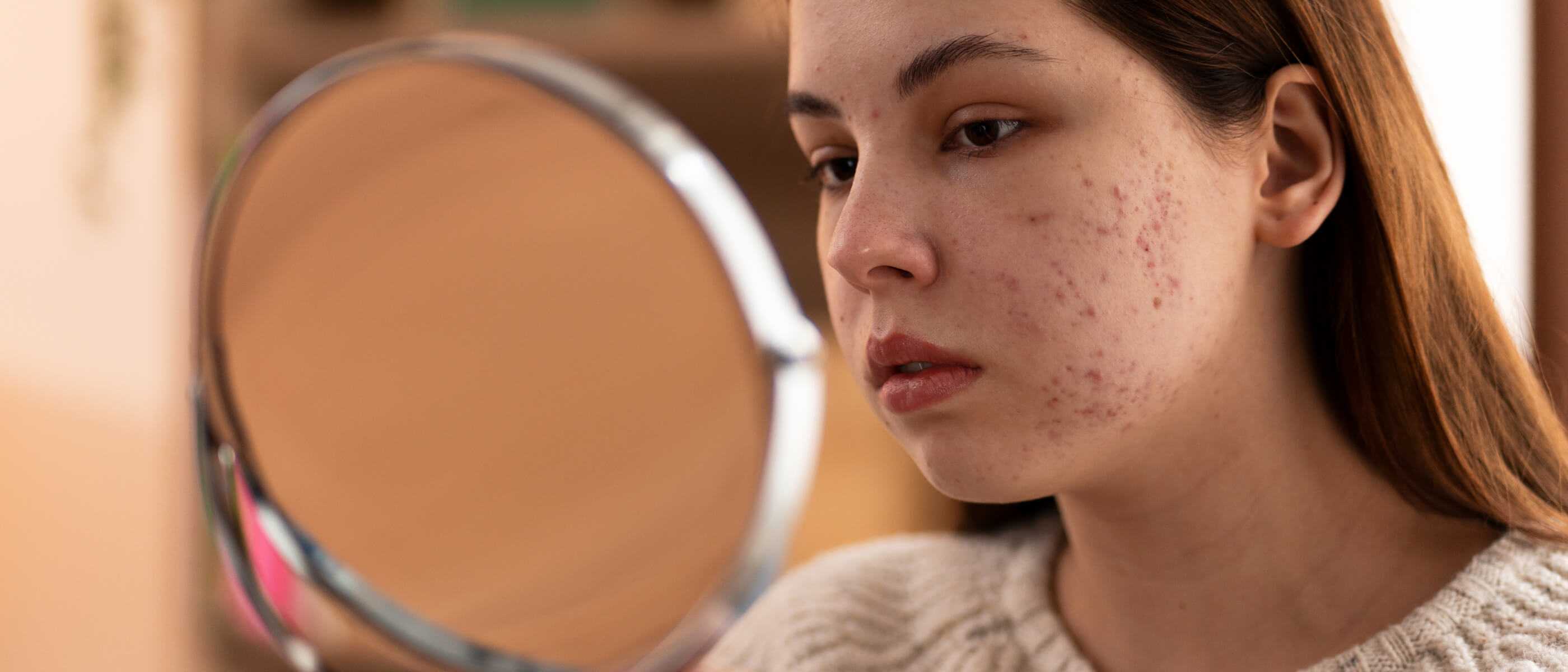 Acne diagnosis and treatment - Warsaw and Płock | OpenMed Medical Centre