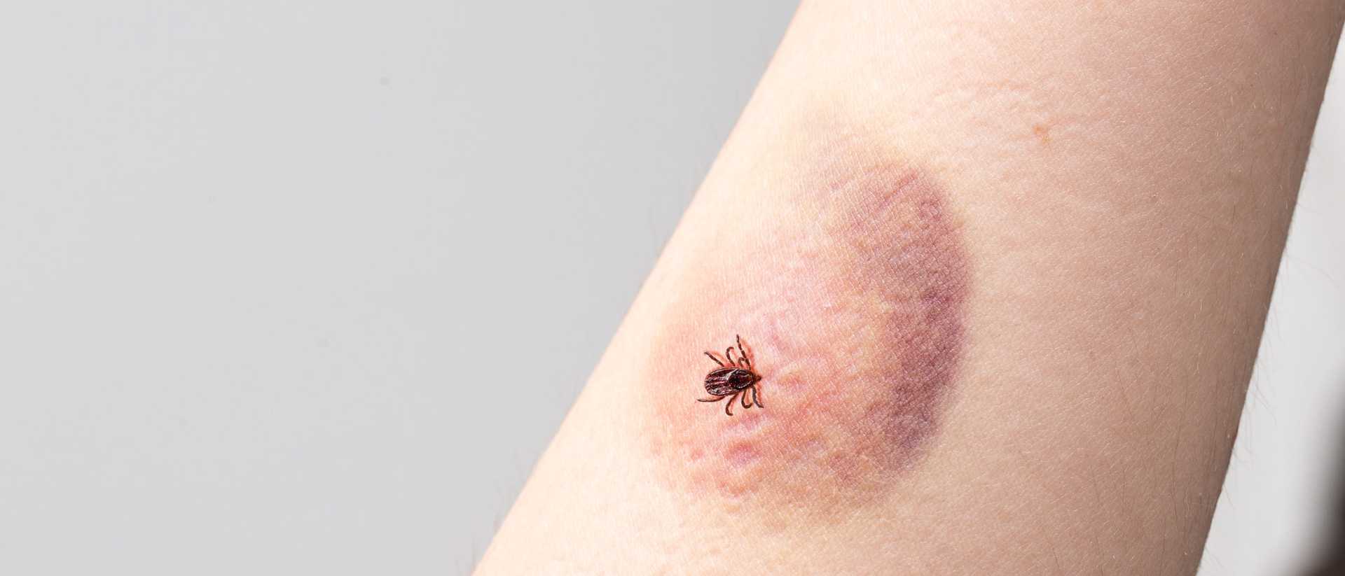 Borelioza a kontakty międzyludzkie – czy można zarazić się od drugiej osoby? Czy można bezpiecznie współżyć z osobą zakażoną boreliozą?