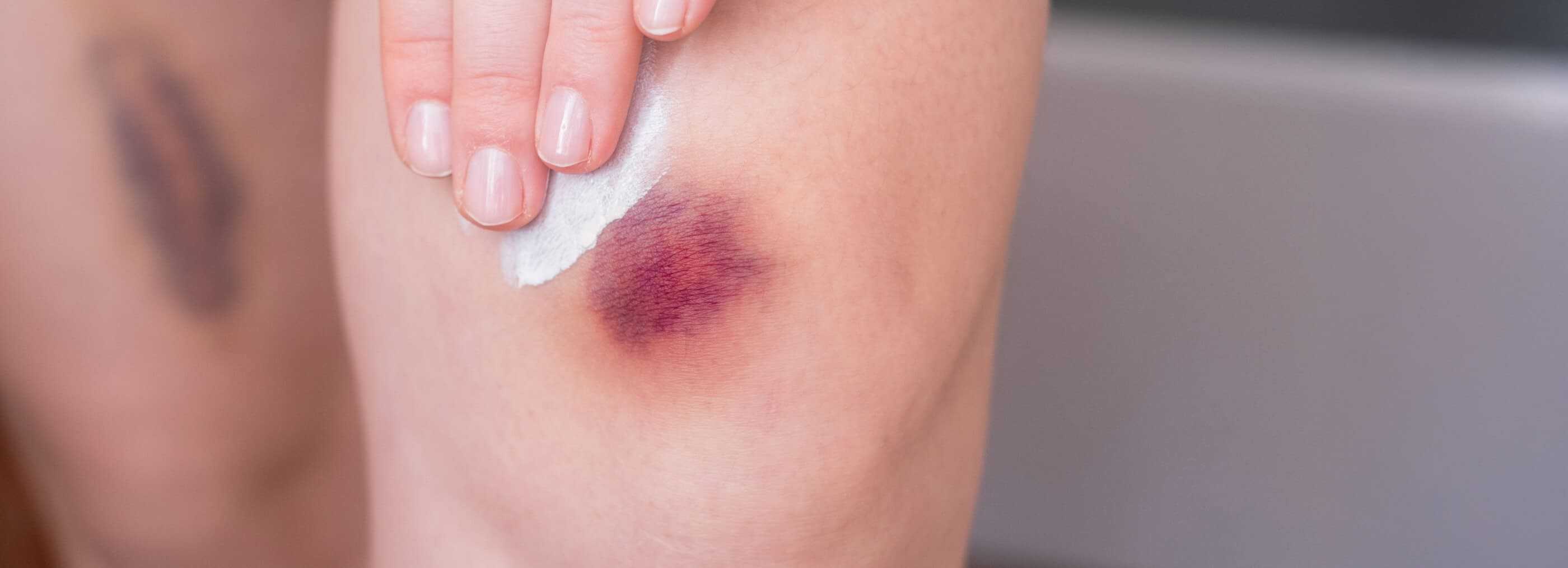 Bruising and easy haematoma diagnosis Warsaw Wola and Płock | OpenMed