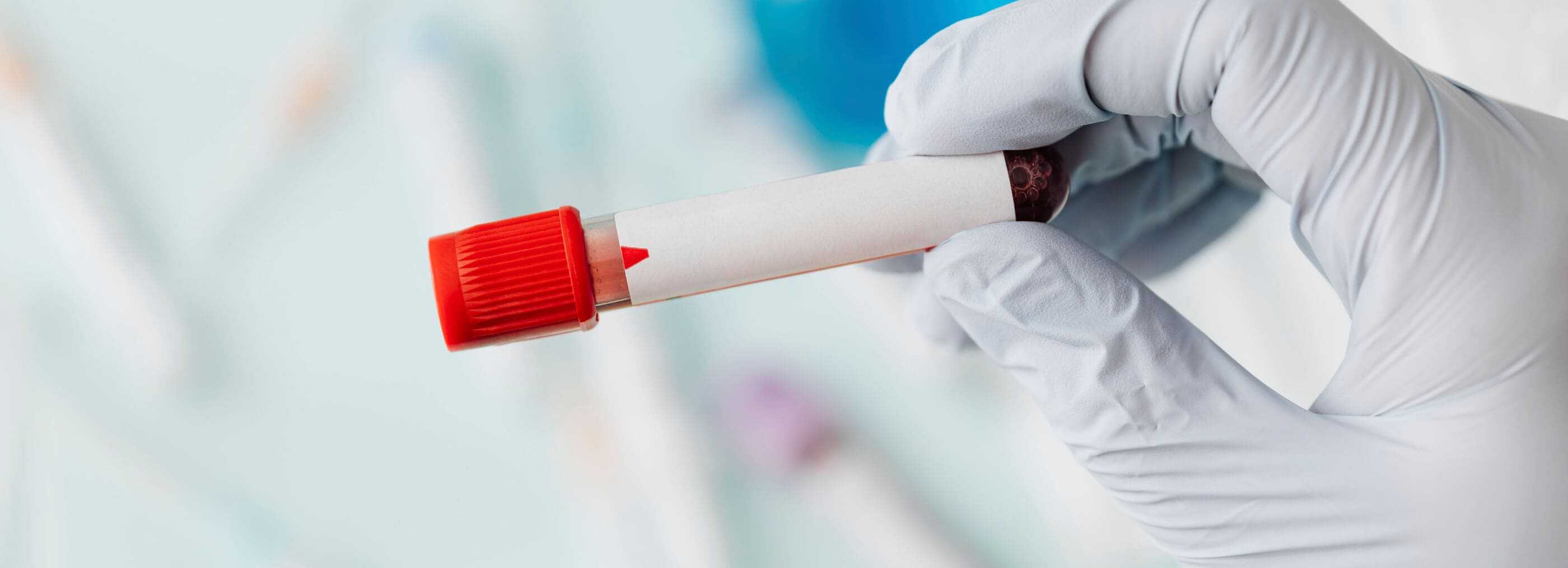 Coagulation disorders diagnosis Warsaw Wola and Płock | OpenMed